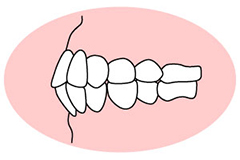 上下顎前突（じょうげがくぜんとつ）