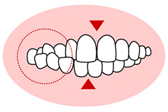 交叉咬合（こうさこうごう）